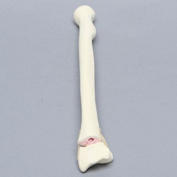Radius with Transverse Colles' Fracture and Removed Tubercle, Foam Cortical