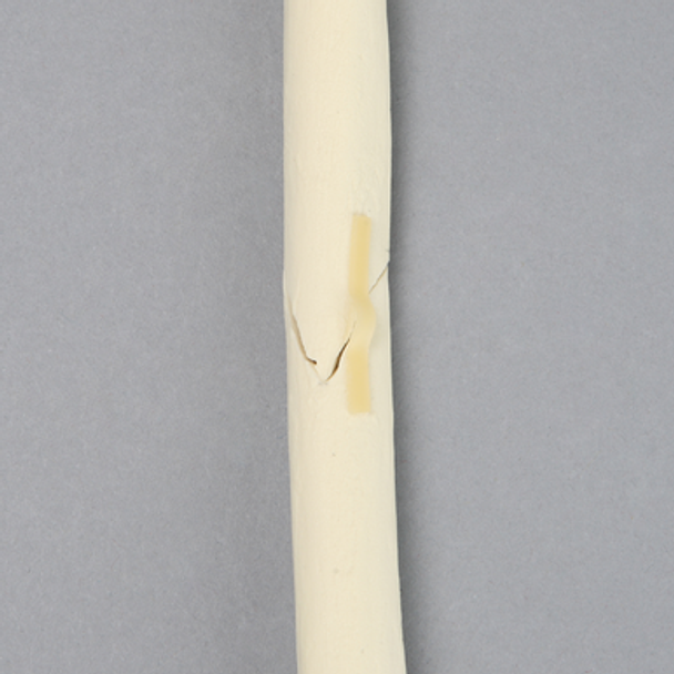 Radius with Oblique Fracture, Solid Foam
