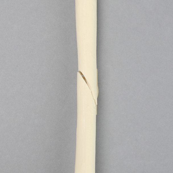 Radius with Oblique Fracture, Solid Foam