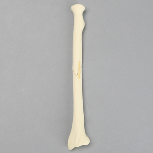 Radius with Oblique Fracture, Solid Foam