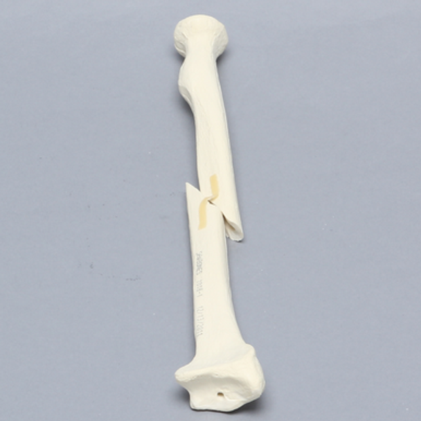 Radius with Short Oblique Fracture, 5.5mm Canal, Solid Foam