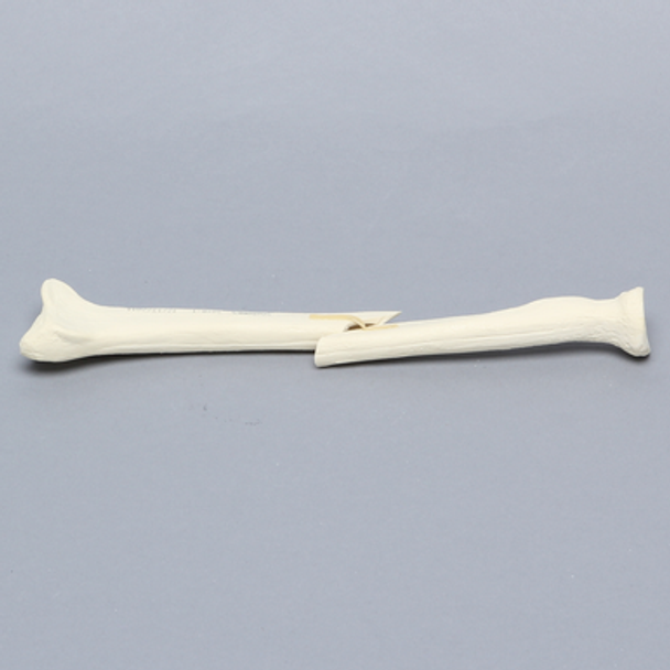 Radius with Short Oblique Fracture, 5.5mm Canal, Solid Foam