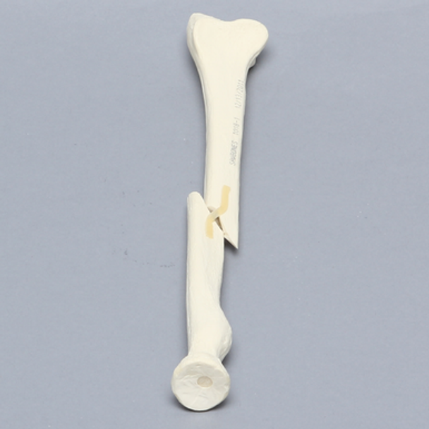 Radius with Short Oblique Fracture, 5.5mm Canal, Solid Foam