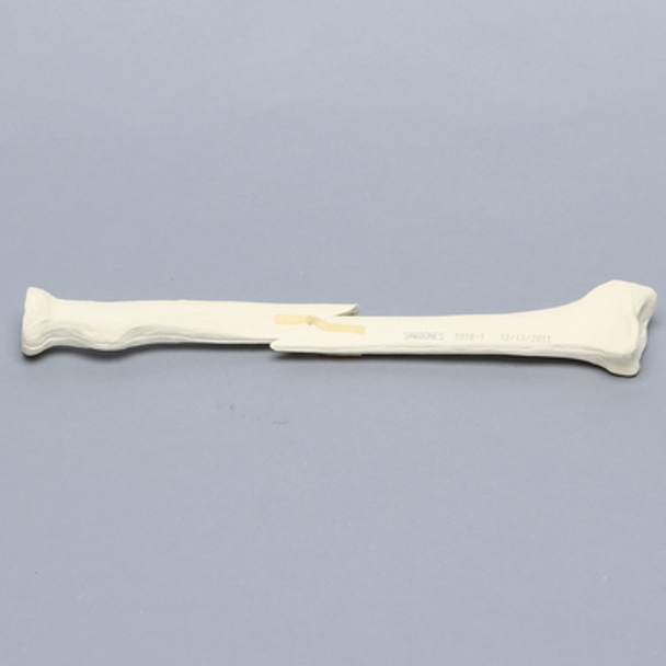 Radius with Short Oblique Fracture, 5.5mm Canal, Solid Foam