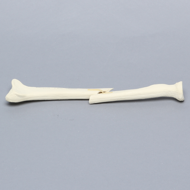 Radius with Short Oblique Fracture, 6.4mm Canal, Solid Foam