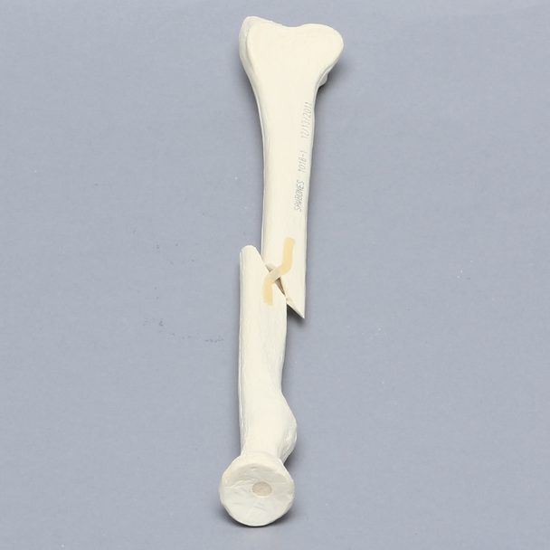 Radius with Short Oblique Fracture, 6.4mm Canal, Solid Foam