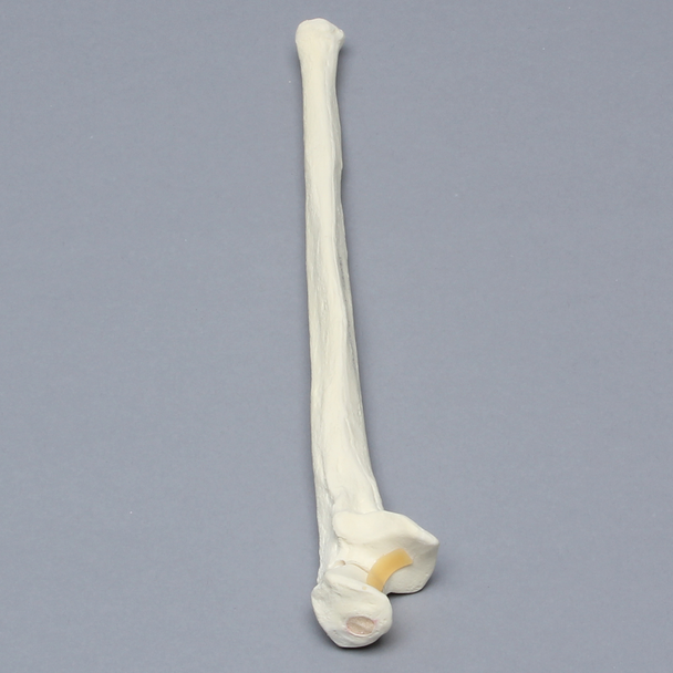 Ulna with Olecranon Fracture, Foam Cortical