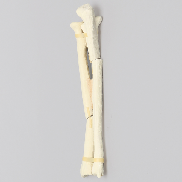 Ulna and Radius with Oblique and Transverse Fractures, Foam Cortical