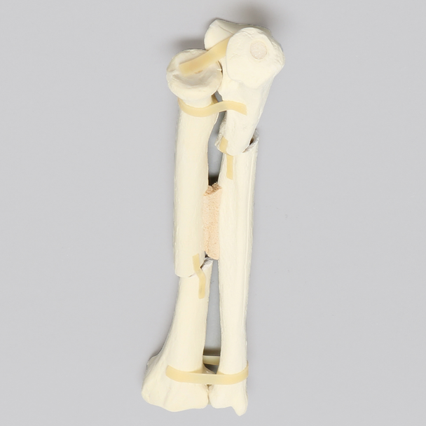 Ulna and Radius with Oblique and Transverse Fractures, Foam Cortical