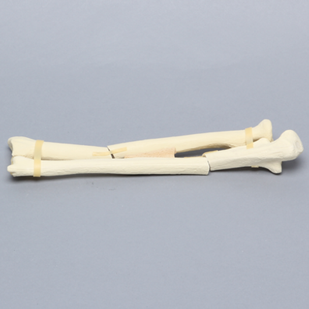 Ulna and Radius with Oblique and Transverse Fractures, Solid Foam