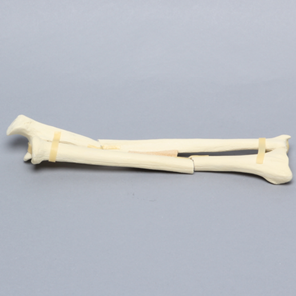 Ulna and Radius with Oblique and Transverse Fractures, Solid Foam