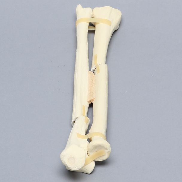 Ulna and Radius with Oblique and Transverse Fractures, Solid Foam