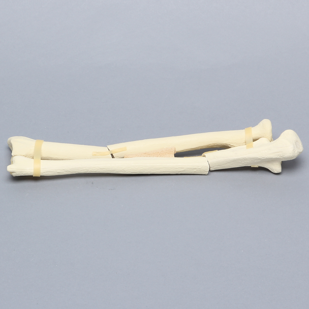 Ulna and Radius with Oblique and Transverse Fractures, Solid Foam