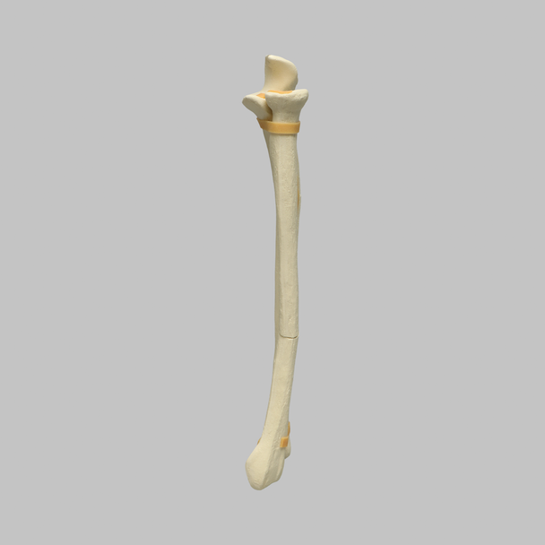 Ulna and Radius with Oblique and Transverse Fractures, Solid Foam
