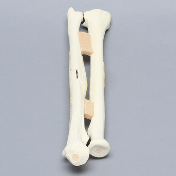 Ulna and Radius with Four-Part and Oblique Fractures, Solid Foam