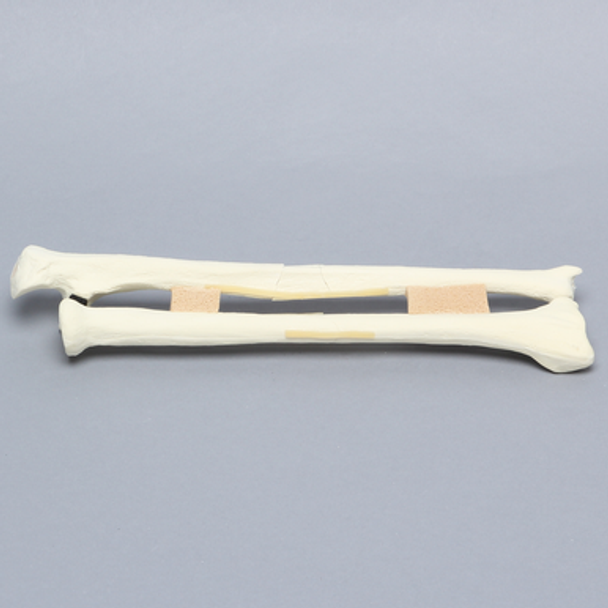 Ulna and Radius with Four-Part and Oblique Fractures, Solid Foam