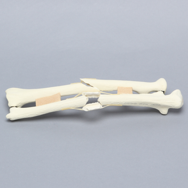 Ulna and Radius with Four-Part and Oblique Fractures, Solid Foam