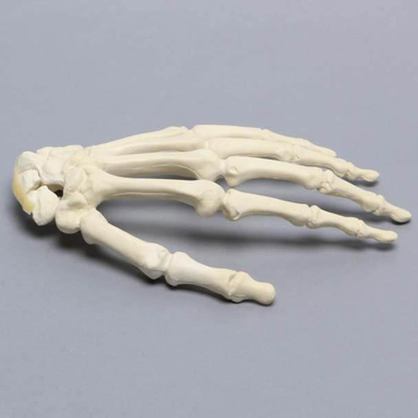 Hand with Scaphoid Fracture, Solid Foam
