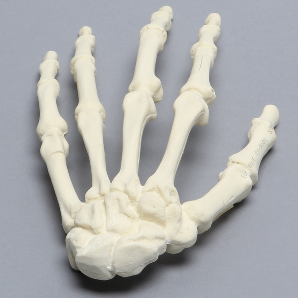 Hand, Multiple Finger Fractures, Solid Foam