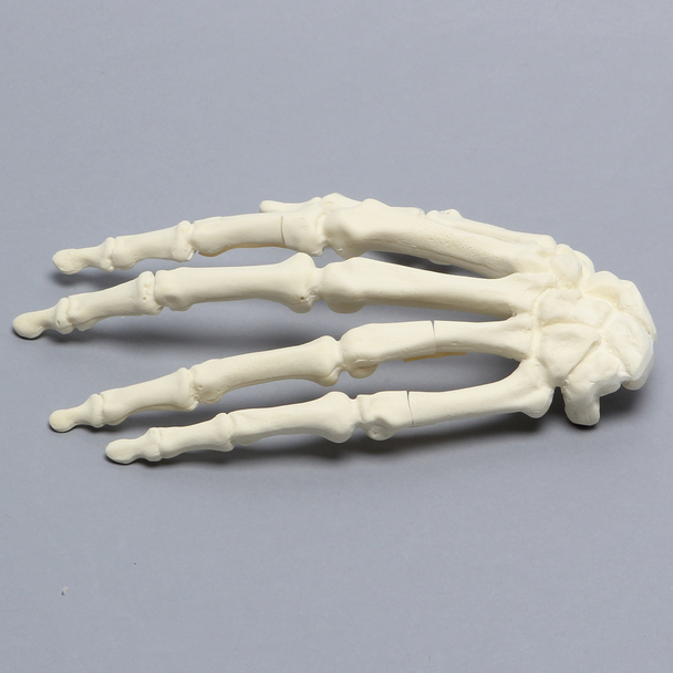 Hand, Multiple Finger Fractures, Solid Foam