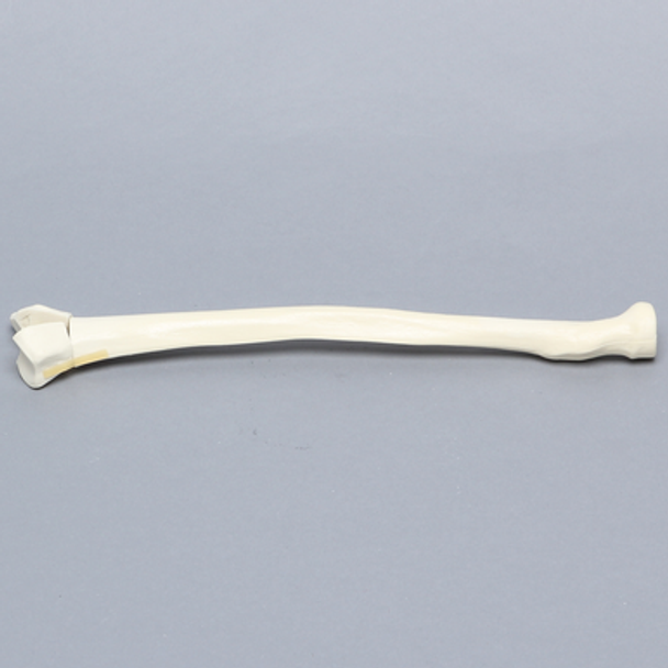 Radius, Three-Part Intra-Articular Fracture, Solid Foam