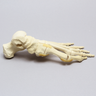 Foot with Valgus Deformity