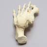 Foot with Valgus Deformity