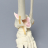 Foot and Ankle with Four-Part Tibial Pilon Fracture