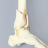 Foot and Ankle with Four-Part Tibial Pilon Fracture