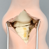 Foot and Ankle with Talar Neck and Six-Part Calcaneal Fracture, Encased