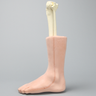 Foot and Ankle with Talar Neck and Six-Part Calcaneal Fracture, Encased