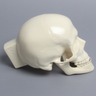 Skull, Full, With Le Fort I, Orbital, Zygomatic, and Mandibular Fractures