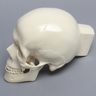 Skull, Full, With Le Fort I, Orbital, Zygomatic, and Mandibular Fractures