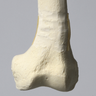 Femur with 10 Degree Varus Deformity