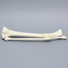 Tibia and Fibula with Malunions, Varus, and Rotation