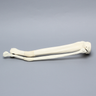 Tibia and Fibula with Malunions, Varus, and Rotation