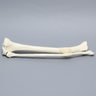 Tibia and Fibula with Malunions, Varus, and Rotation