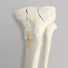Tibia with Bicondylar and Transverse Fractures and Intact Fibula