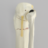 Tibia with Bicondylar and Transverse Fractures and Intact Fibula
