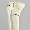 Tibia with Bicondylar and Transverse Fractures and Intact Fibula