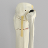 Tibia with Bicondylar and Transverse Fractures and Intact Fibula