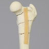 Canine Femur with Four-Part Comminuted Fracture