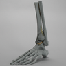 Foot and Ankle with Fracture and Radiopaque Bones, Encased