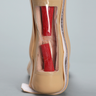 Encased Foot and Ankle with Achilles Ligament
