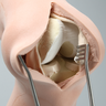 Knee, Encased