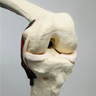 Knee, ACL with 3.2 mm/10 mm Step Tunnel , Solid Foam