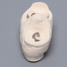 Meniscal Insert with Peripheral and Flap Tears