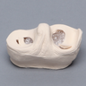 Meniscal Insert with Peripheral and Flap Tears