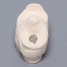 Meniscal Insert, includes Bucket-Handle Tear and Parrot-Beak Pathology