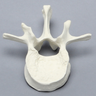Vertebra, L1, Fractured, Solid Foam